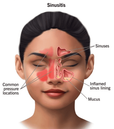 Study: Surgery More Effective Than Antibiotics in Treating Chronic Sinus Disease