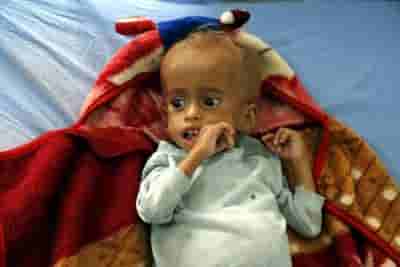 Govt to launch nutrition drive for severely acute malnourished children