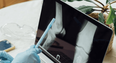 Indian Researchers Create Portable Device for Early Detection of Bone Cancer