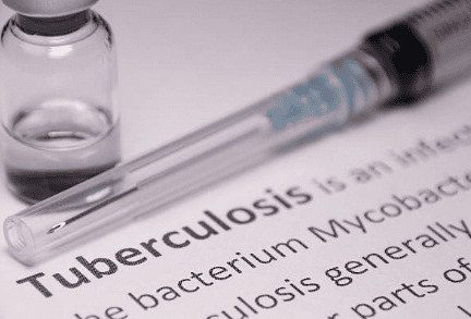 Molecular stool test shows promise for TB diagnosis in adults with HIV: Study
